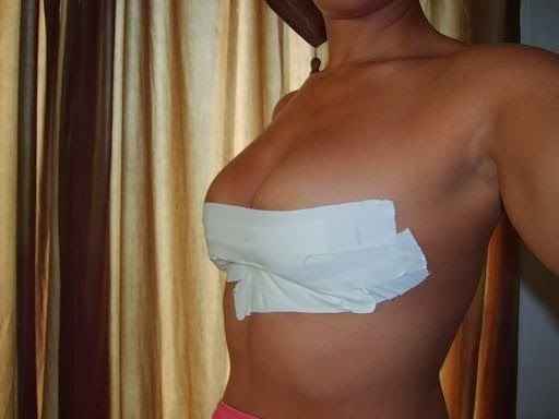 breast taping 2