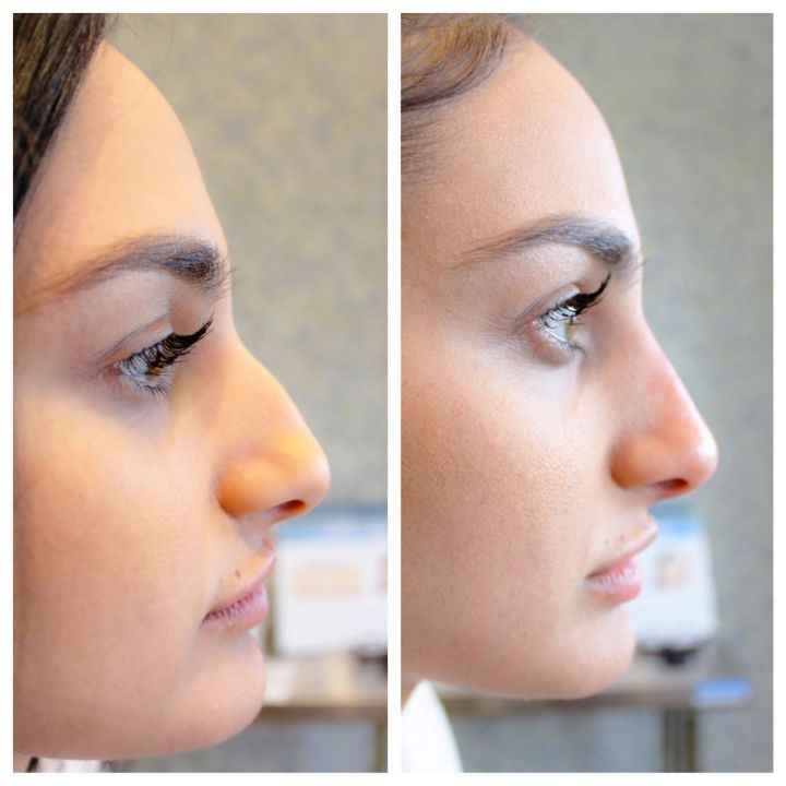 Nose fillers (nariz perfeito sem operacao) - 1
