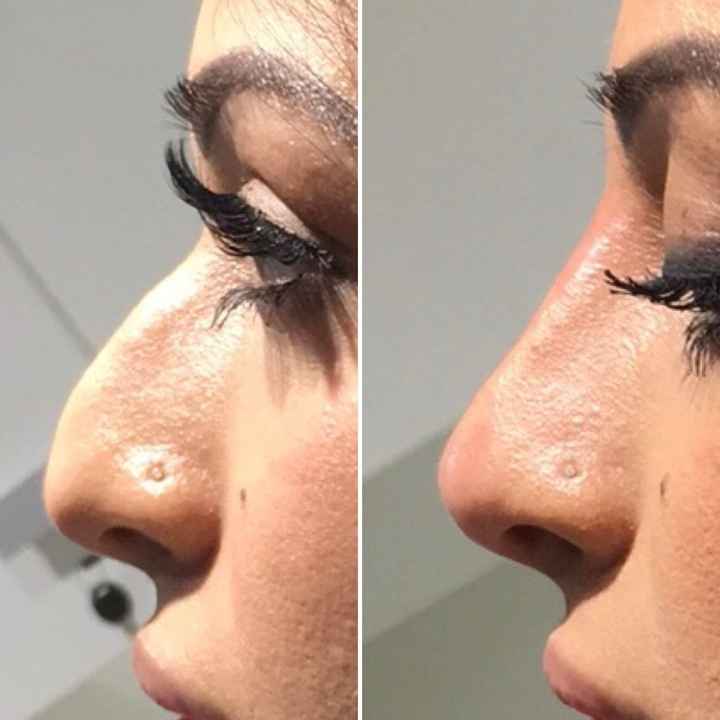 Nose fillers (nariz perfeito sem operacao) - 2