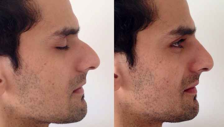 Nose fillers (nariz perfeito sem operacao) - 3