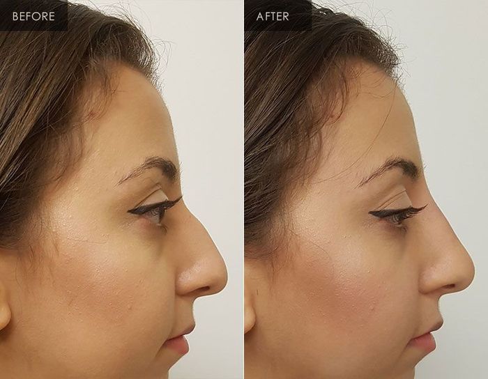 Nose fillers (nariz perfeito sem operacao) - 4