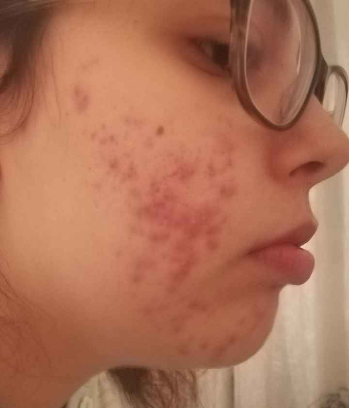 Jornada contra o acne - preparação para o grande dia - 1