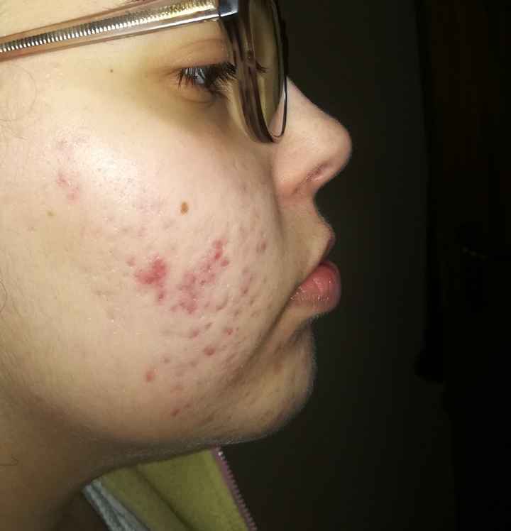 Jornada contra o acne - preparação para o grande dia - 2