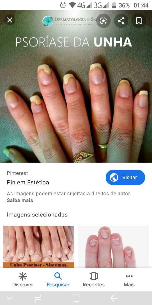 Unhas com psoríase - 1