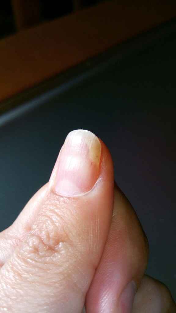 Unhas com psoríase - 1