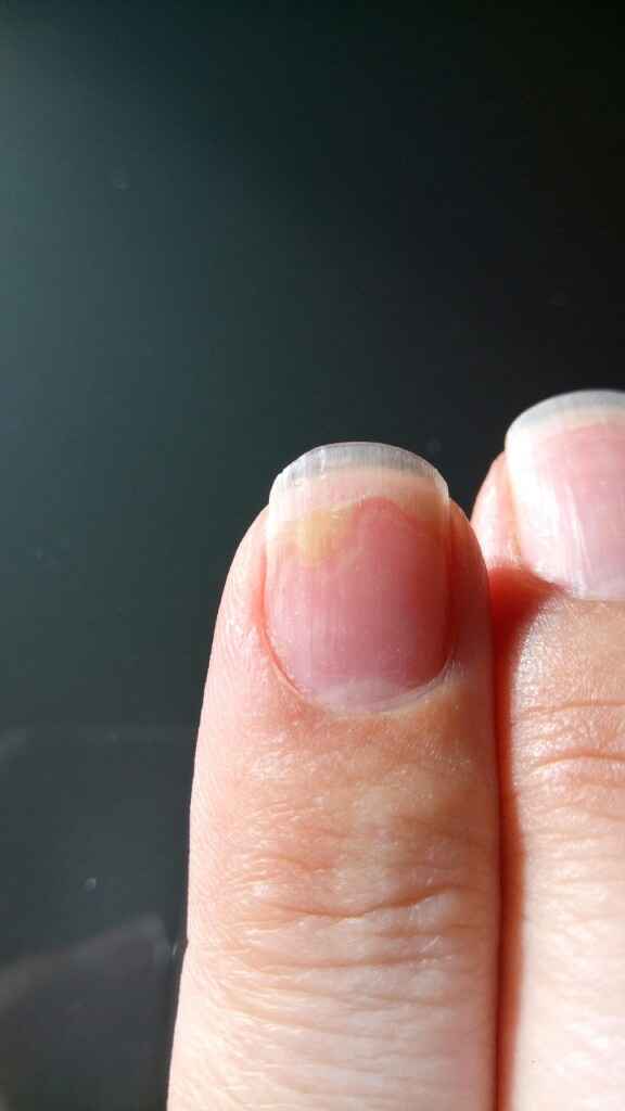 Unhas com psoríase - 2