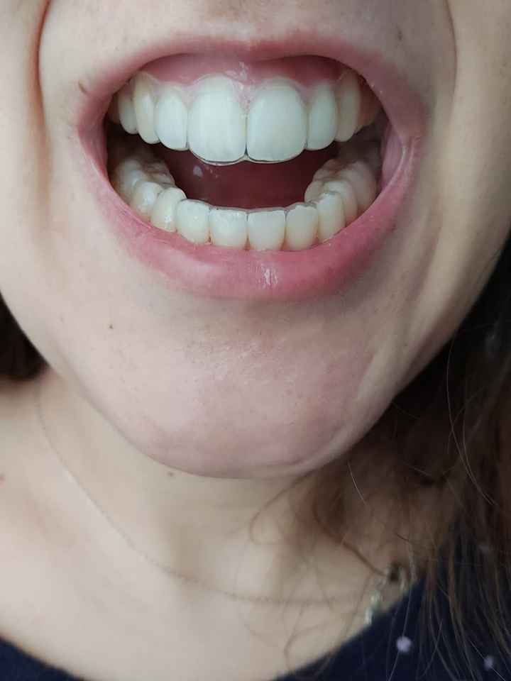 Branqueamento de Dentes em Casa (aconselhado pelo Dentista) - 1