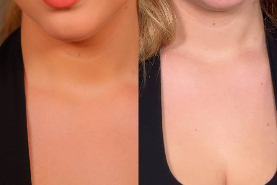 Before and After